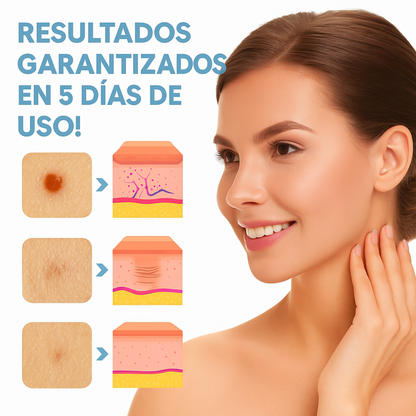 WipeOff™ Eliminador de Verrugas – Seguro, Indoloro y de Uso en Casa